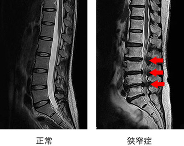 院長の脊柱管狭窄症対策